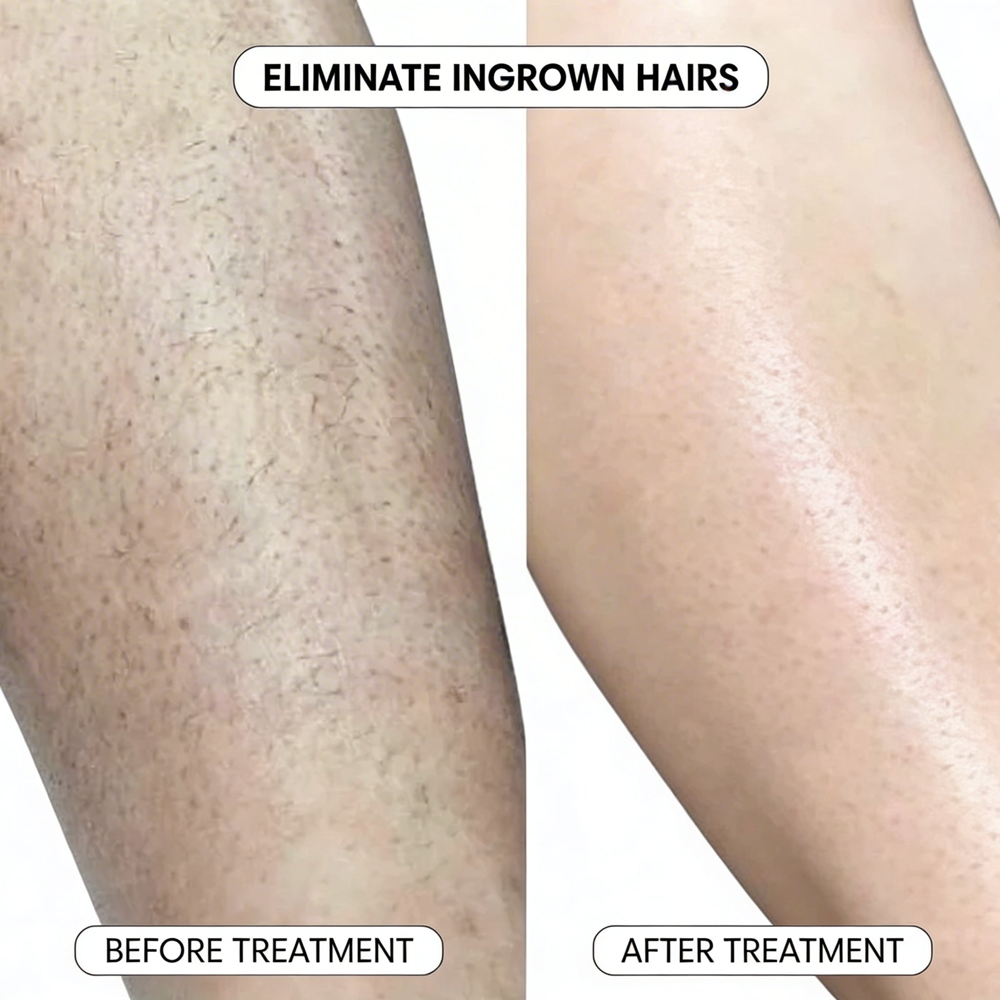 SmoothRoll Ingrown Hair Solution
