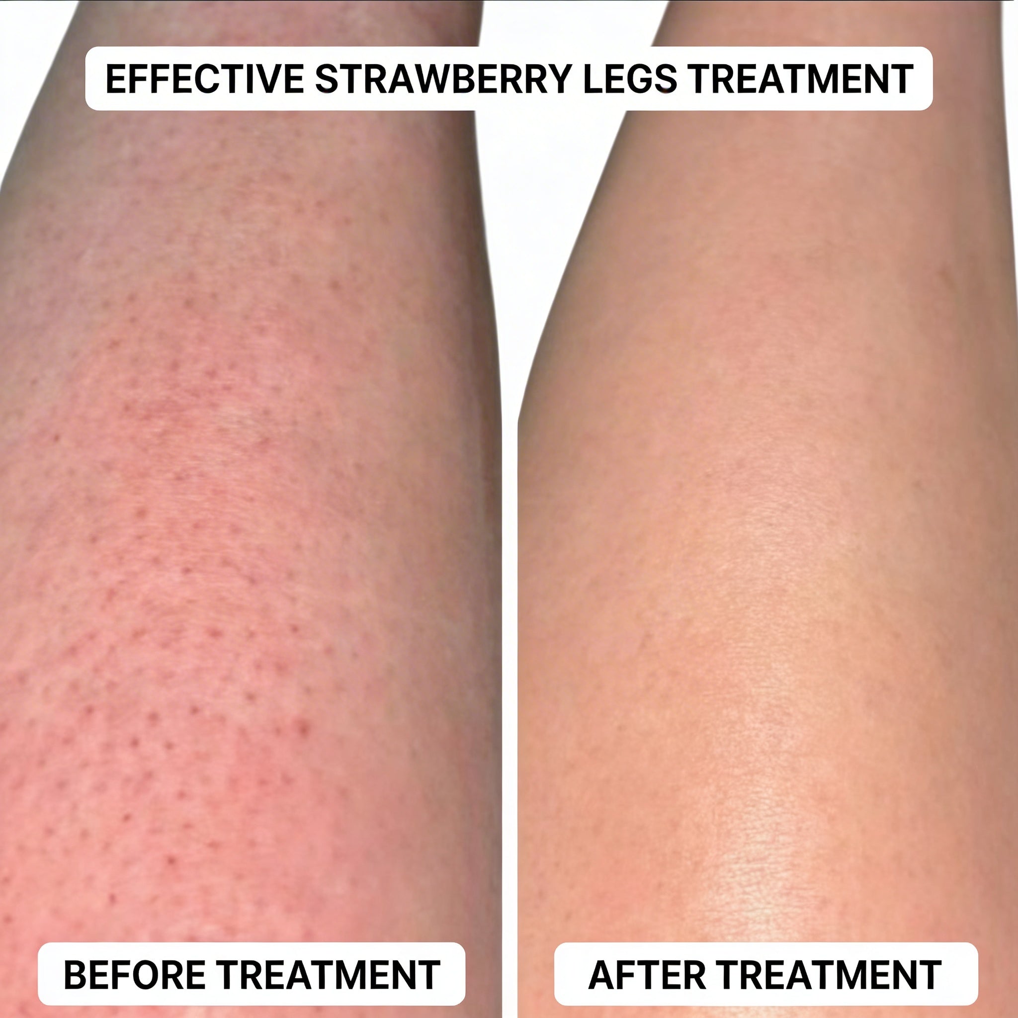 SmoothRoll Ingrown Hair Solution