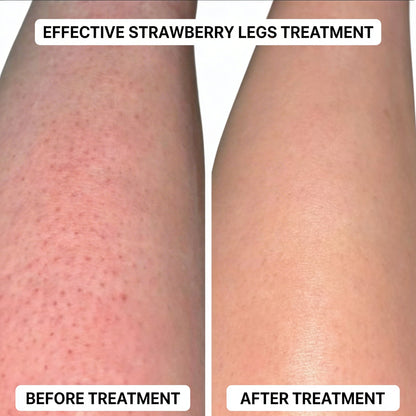 SmoothRoll Ingrown Hair Solution